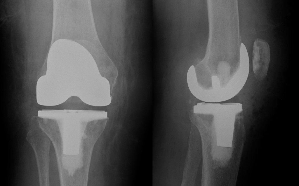 X-rays showing front (left image) and side (right image) views of a total knee replacement.