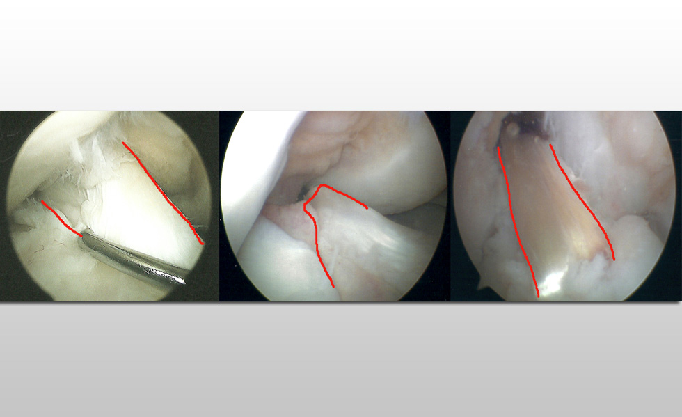 SliderKneeImage2