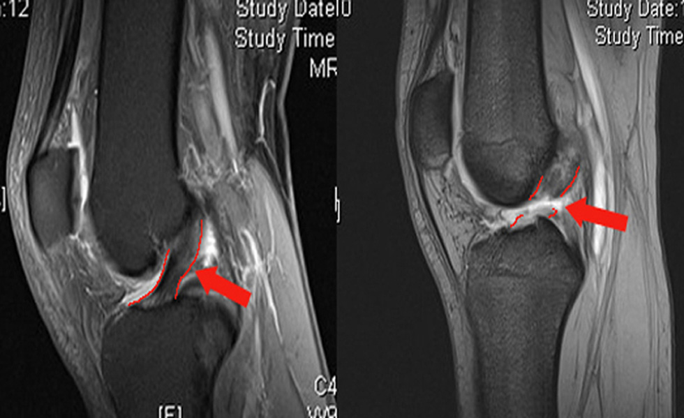 SliderKneeImage3